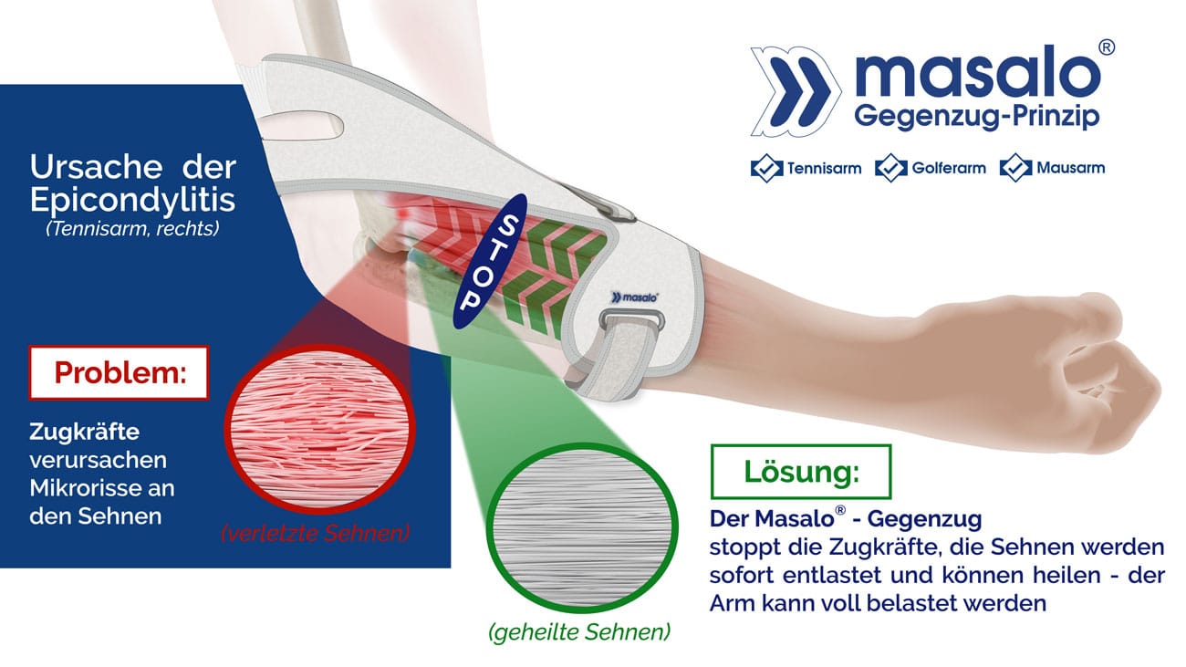 Masalo Cuff Effective For Tennis Elbow Golfer s Elbow Mouse Elbow masalo-cuff-effective-for-tennis-elbow-golfer-s-elbow-mouse-elbow